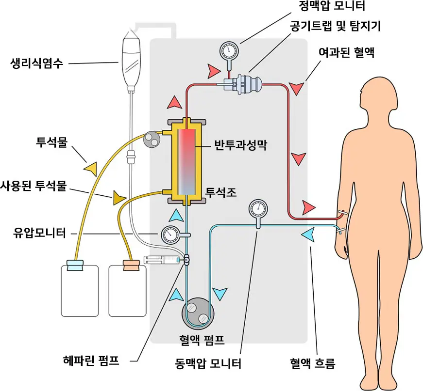투석기의 작동기전 혈액이 동맥압모니터를 지나고 혈액펌프를 지난 후 투석종의 반투과성막을 지나 정맥압모니터, 공기트랩 및 탐지기를 거친 후 여과된 혈액이 다시 공급됩니다.