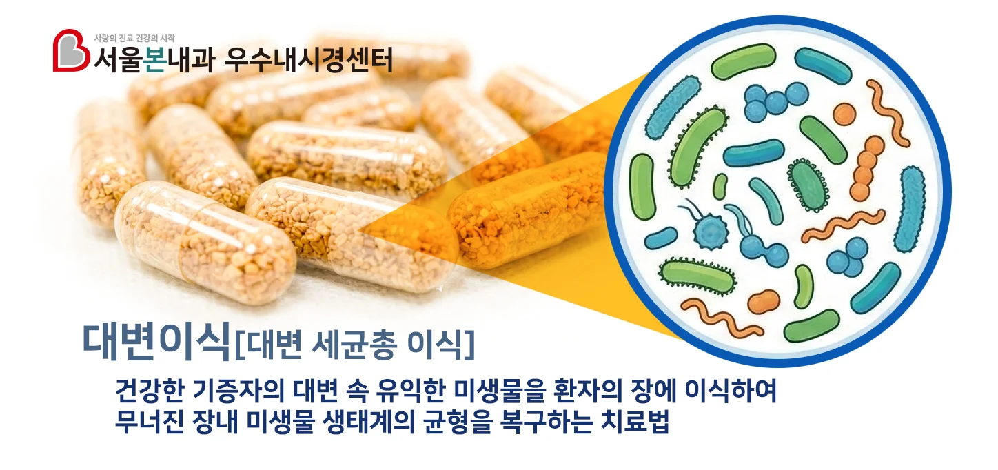 서울본내과 대변이식 - 건강한 기증자의 대변 속 유익한 미생물을 환자의 장에 이식하여 무너진 장내 미생물 생태계의 균형을 복구하는 치료법